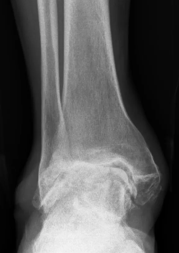 Ankle arthritis