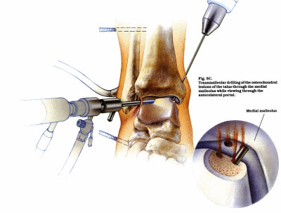 Ankle Arthroscopy | Peter Rosenfeld FRCS, London