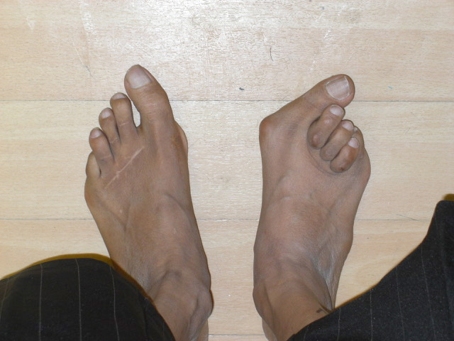 heel pain after bunion surgery