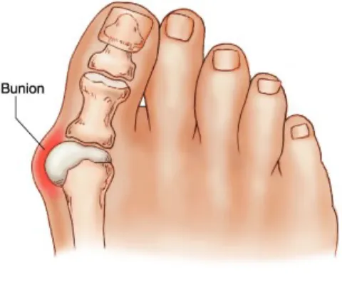 What is a bunion