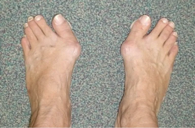 Do bunions get worse