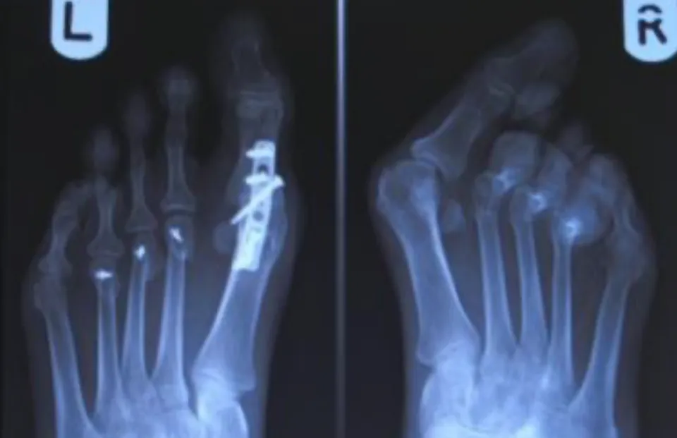 Bunion Surgery Risks