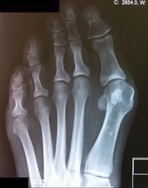 Hallux valgus x-ray