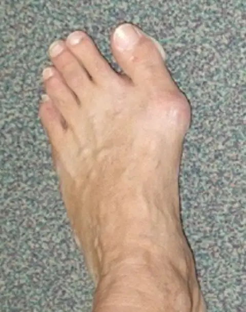 Hallux valgus bunion