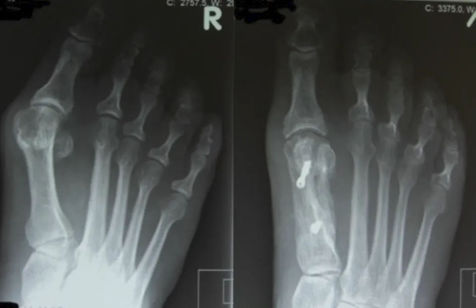 Bunion Metatarsal Osteotomies (Chevron or Scarf Osteotomy)