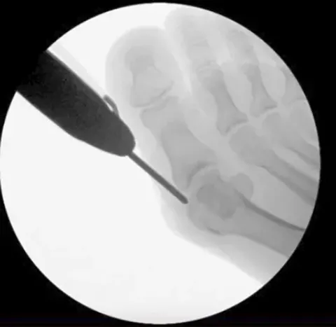 Bunion Minimally Invasive Keyhole