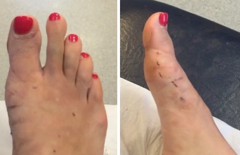 Minimally Invasive Bunion Surgery