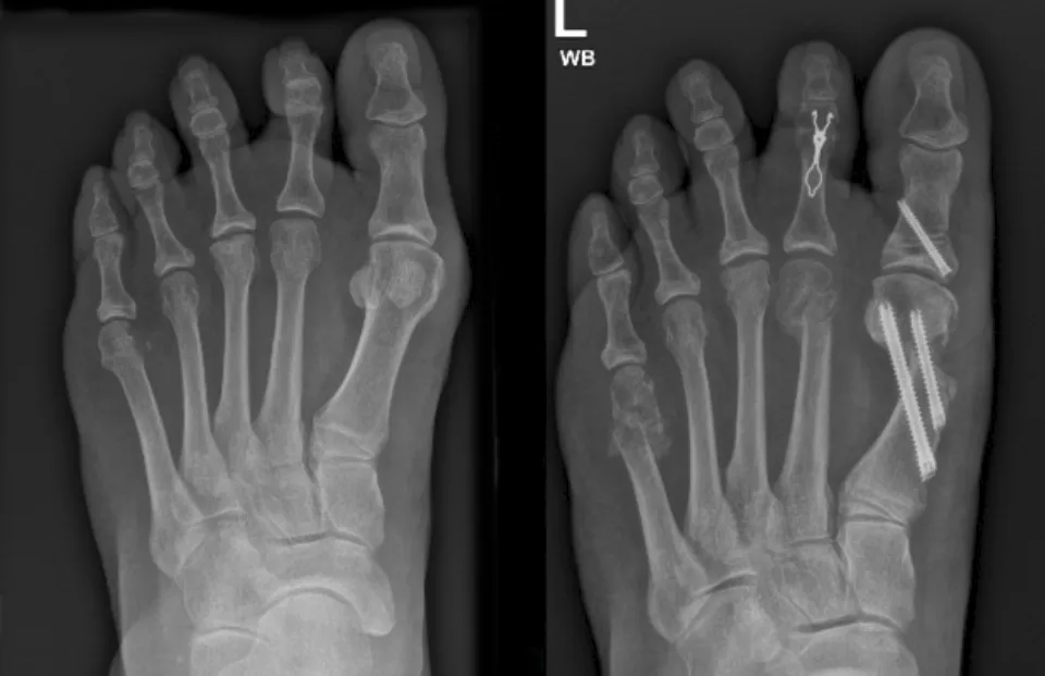 Minimally Invasive Bunion Xray