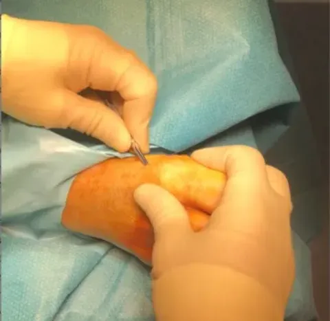 Bunion Minimally Invasive