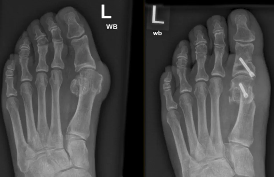 Bunion Mixed MI & Open surgery