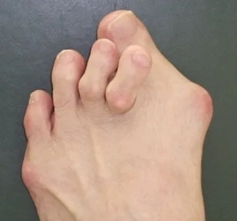 Severe Hallux valgus with lesser toe deformities