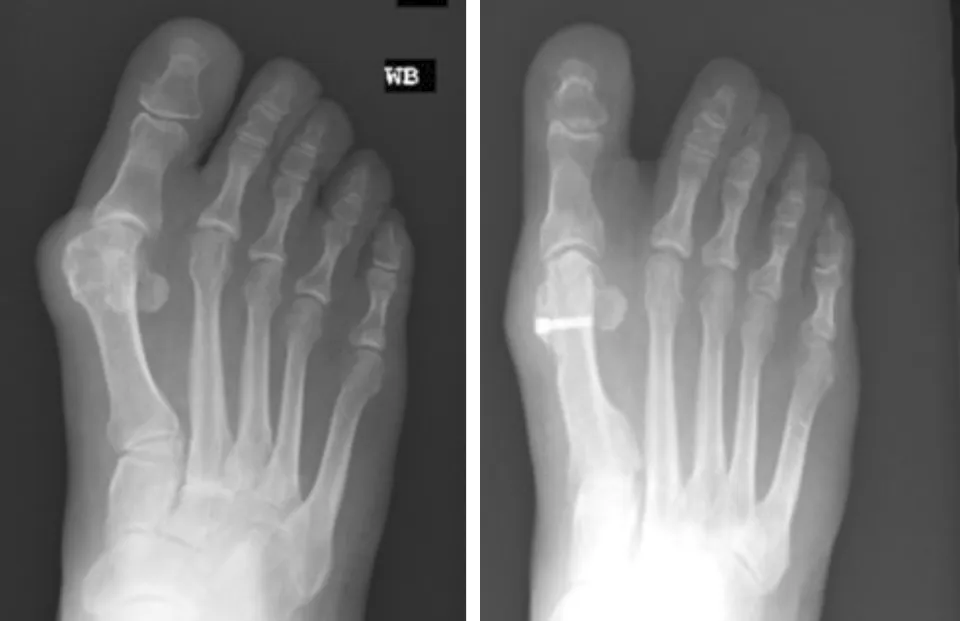 Bunion Simplest Hallux Valgus correction