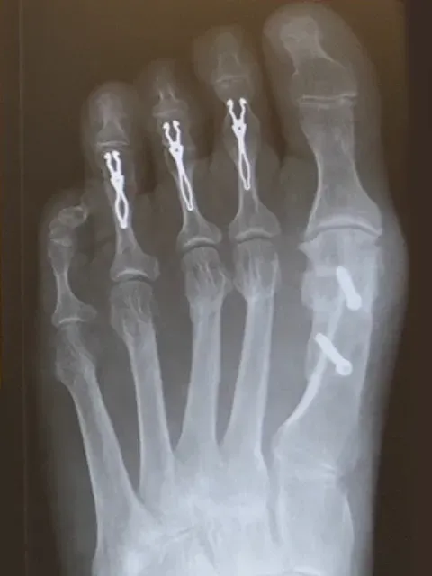 Bunion Severe Hallux Valgus Xray